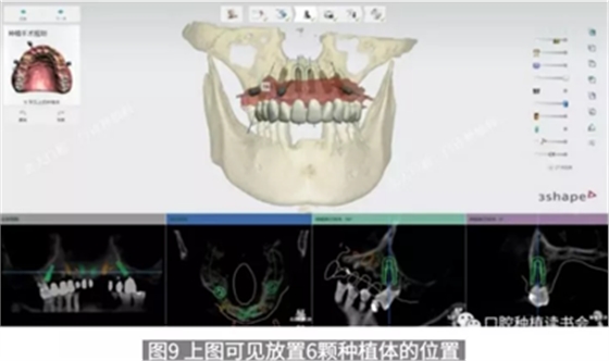 病例報道│全程數(shù)字化輔助無牙頜種植即刻負重
