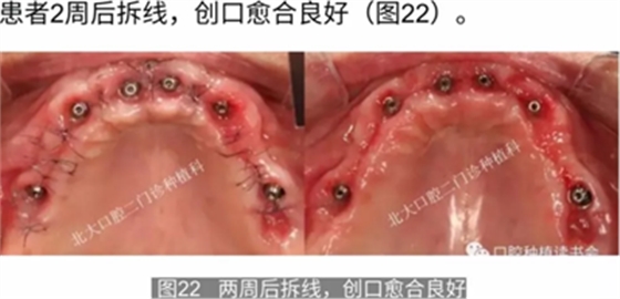 病例報道│全程數(shù)字化輔助無牙頜種植即刻負重