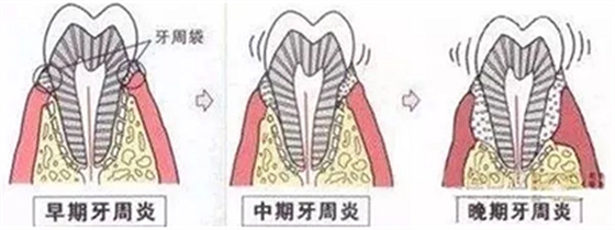 上海嘉福口腔研究所二十一世紀(jì)牙周病的臨床進(jìn)展