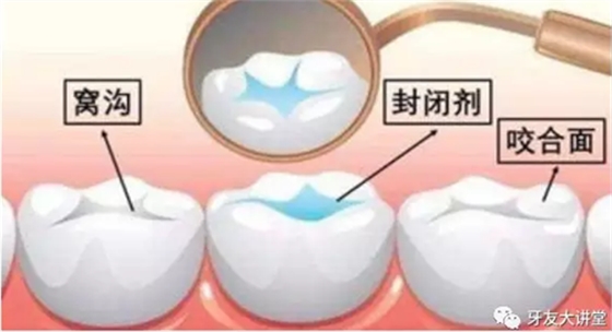 兒童防齲齒【窩溝封閉】和【涂氟】是一回事兒嗎？