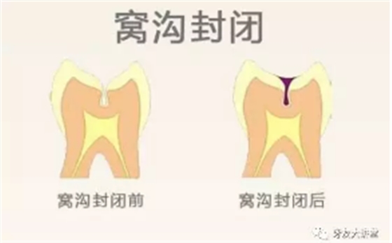 兒童防齲齒【窩溝封閉】和【涂氟】是一回事兒嗎？