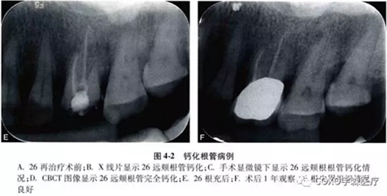 （六期）細小鈣化根管的疏通——病因及診斷