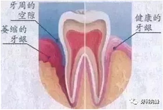 	牙齦萎縮是不治之癥？緩解牙齦萎縮5步走！