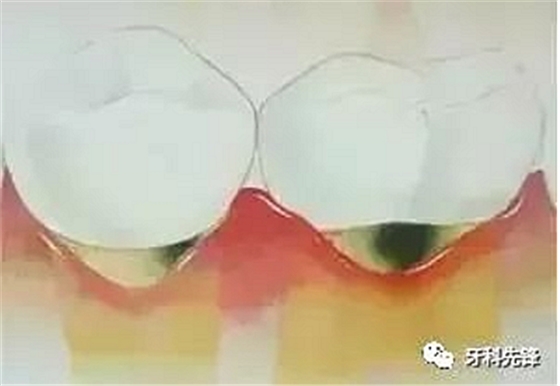 	牙齦萎縮是不治之癥？緩解牙齦萎縮5步走！
