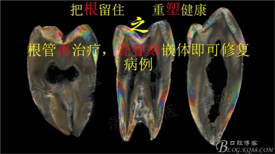 根管再治療，高嵌體即可修復（濟南牙醫(yī)~ 李強）