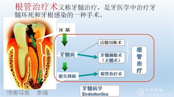 根管再治療，高嵌體即可修復（濟南牙醫(yī)~ 李強）