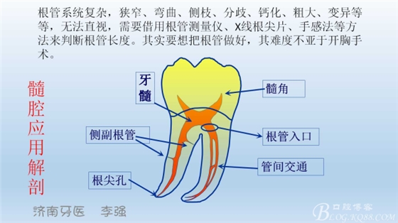 根管再治療，高嵌體即可修復（濟南牙醫(yī)~ 李強）