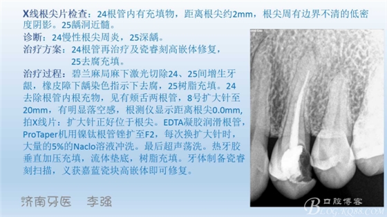 根管再治療，高嵌體即可修復（濟南牙醫(yī)~ 李強）