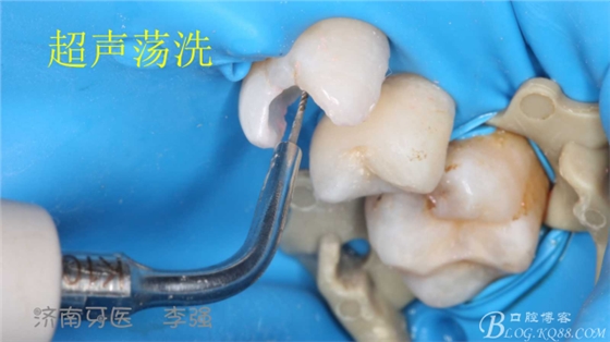 根管再治療，高嵌體即可修復（濟南牙醫(yī)~ 李強）