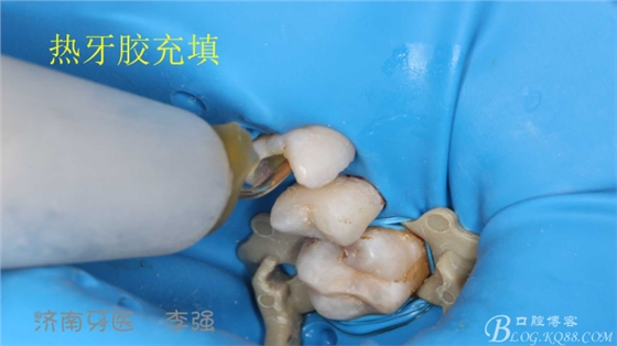 根管再治療，高嵌體即可修復（濟南牙醫(yī)~ 李強）