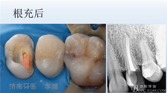 根管再治療，高嵌體即可修復（濟南牙醫(yī)~ 李強）