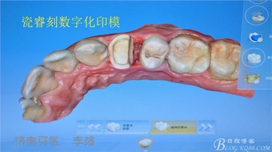 根管再治療，高嵌體即可修復（濟南牙醫(yī)~ 李強）