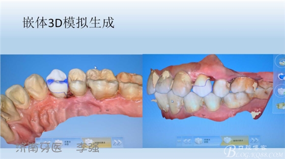 根管再治療，高嵌體即可修復（濟南牙醫(yī)~ 李強）