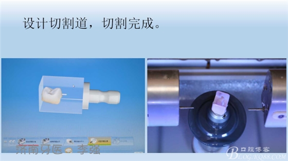 根管再治療，高嵌體即可修復（濟南牙醫(yī)~ 李強）