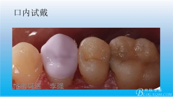 根管再治療，高嵌體即可修復（濟南牙醫(yī)~ 李強）