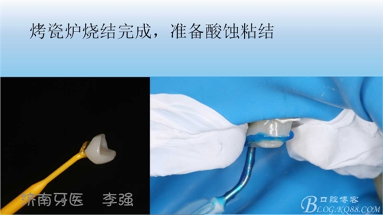 根管再治療，高嵌體即可修復（濟南牙醫(yī)~ 李強）