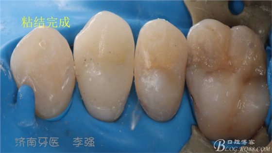 根管再治療，高嵌體即可修復（濟南牙醫(yī)~ 李強）