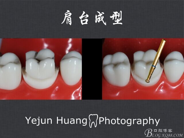 黃葉君：淺談口腔固定修復流程]第四期：后牙的預備流程