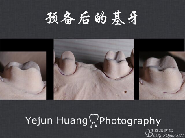 黃葉君：淺談口腔固定修復流程]第四期：后牙的預備流程
