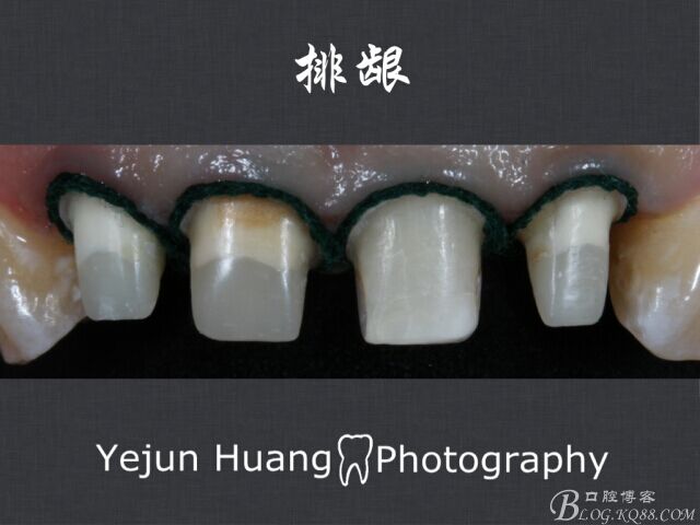 黃葉君：淺談口腔固定修復流程]第四期：后牙的預備流程