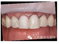 義獲嘉貼面粘接的操作步驟！