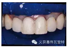 義獲嘉貼面粘接的操作步驟！