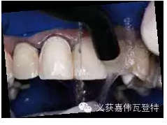 義獲嘉貼面粘接的操作步驟！