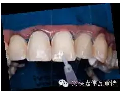 義獲嘉貼面粘接的操作步驟！