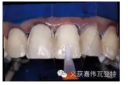 義獲嘉貼面粘接的操作步驟！