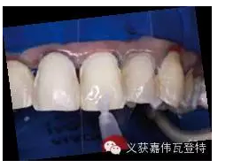 義獲嘉貼面粘接的操作步驟！