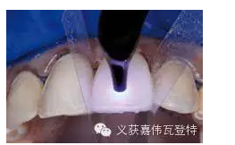 義獲嘉貼面粘接的操作步驟！