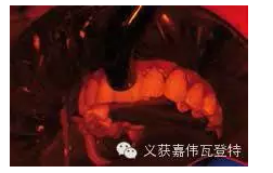 義獲嘉貼面粘接的操作步驟！
