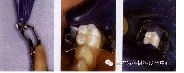 橡皮障技術(shù)、四種安裝方法以及疑難處理