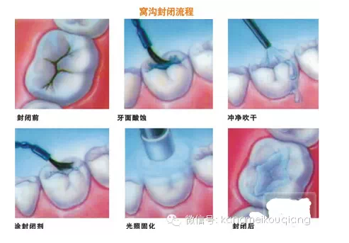 口腔窩溝封閉，就如同給牙齒穿上了一層保護衣，使牙齒免受食物侵蝕。原理：窩溝封閉后，窩溝內原有的細菌斷。