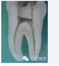 彎曲根管預備的方法和技巧
