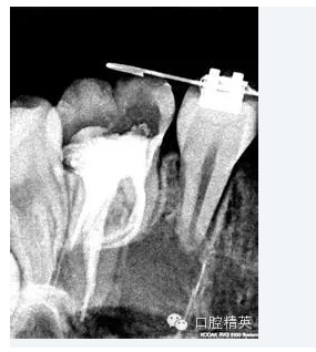 彎曲根管預備的方法和技巧