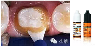 即刻牙本質封閉