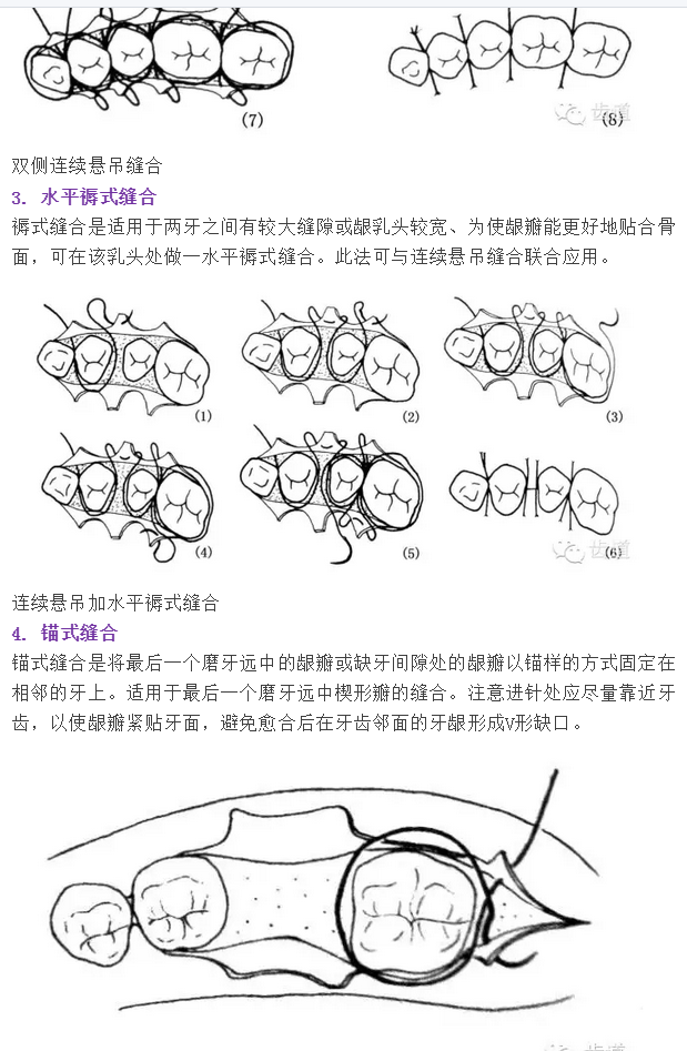 牙醫基本技能：口內縫合術（文字、示意圖及視頻）