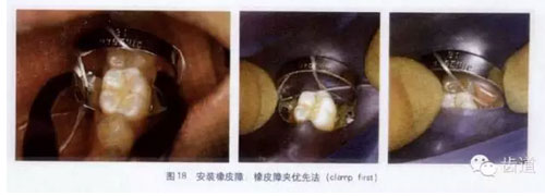 橡皮障的臨床運用大全 橡皮障的臨床運用大全