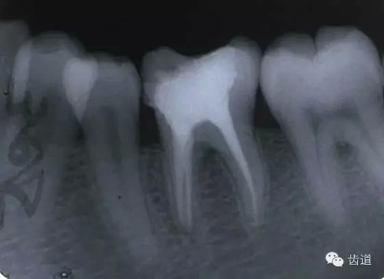 根管治療的并發癥及處理