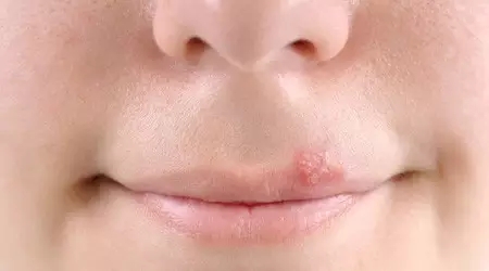 這十種常見口腔疾病，你有遇到過么？