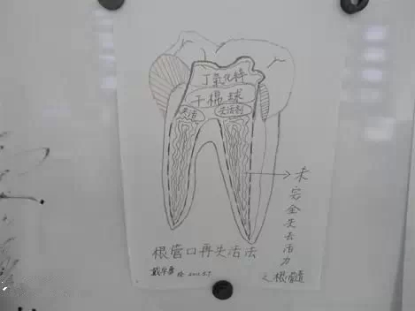 牙科醫生必收藏：實用簡單清理殘髓（干貨分享）