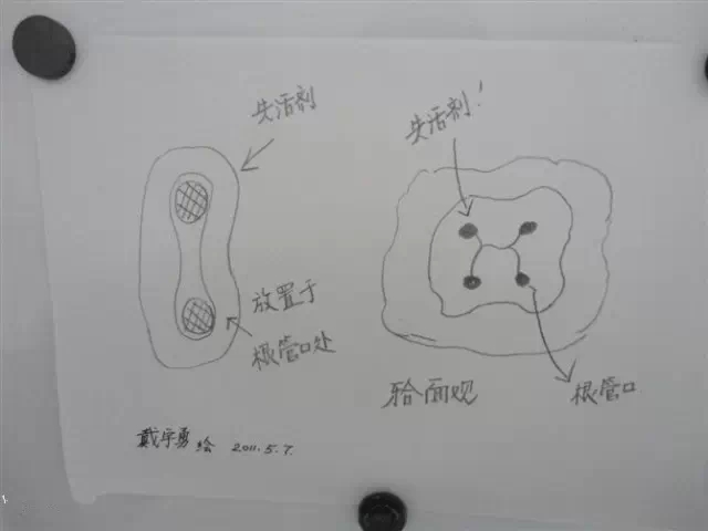 牙科醫生必收藏：實用簡單清理殘髓（干貨分享）