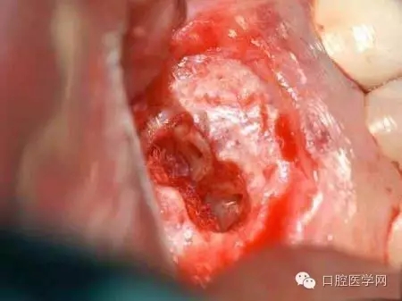 根尖切除術操作全過程