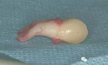 拔牙斷根了怎么辦？