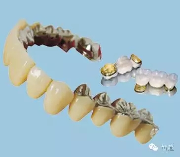 為何烤瓷牙的價格從幾百元至數(shù)千元不等？告訴您11種烤瓷牙的特點、價格及優(yōu)缺點
