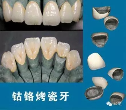 為何烤瓷牙的價格從幾百元至數(shù)千元不等？告訴您11種烤瓷牙的特點、價格及優(yōu)缺點