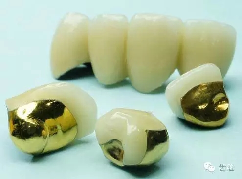 為何烤瓷牙的價格從幾百元至數(shù)千元不等？告訴您11種烤瓷牙的特點、價格及優(yōu)缺點