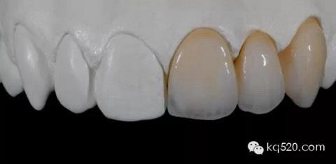 烤瓷牙邊緣變黑，要換新的嗎？