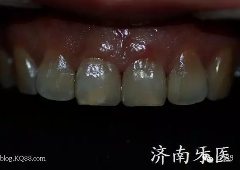 四環素牙修復真實操作.png